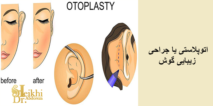 اتوپلاستی چیست؟