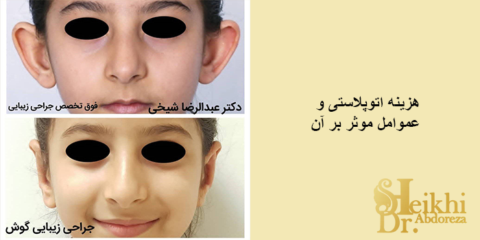 هزینه اتوپلاستی