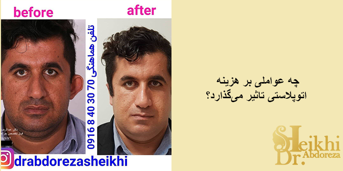 چه عواملی بر هزینه اتوپلاستی تاثیر می‌گذارد؟