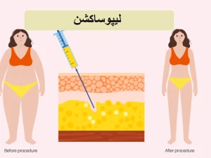 لیپوساکشن