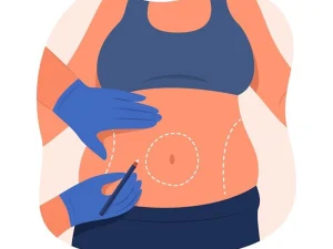 دوره نقاهت ابدومینوپلاستی