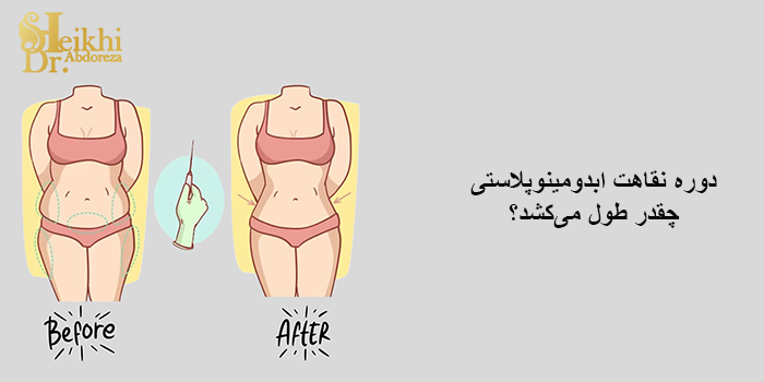 دوره نقاهت ابدومینوپلاستی