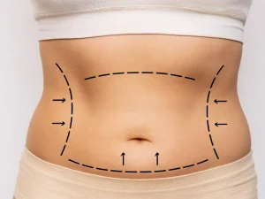 ورزش بعد از ابدومینوپلاستی