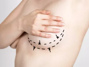 انواع برش در پروتز سینه