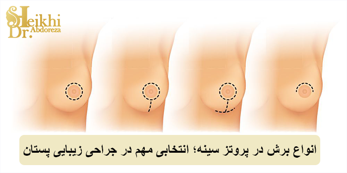 انواع برش در پروتز سینه؛ انتخابی مهم در جراحی زیبایی پستان