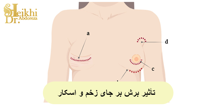 تأثیر برش بر جای زخم و اسکار