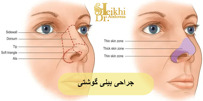جراحی بینی گوشتی در اهواز + فیلم نمونه کار عمل بینی 