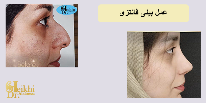 عمل بینی فانتزی در اهواز + فیلم نمونه کار واقعی