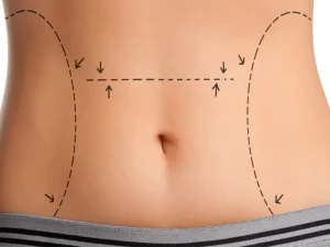 هزینه ابدومینوپلاستی