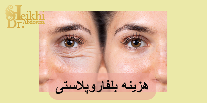 هزینه بلفاروپلاستی