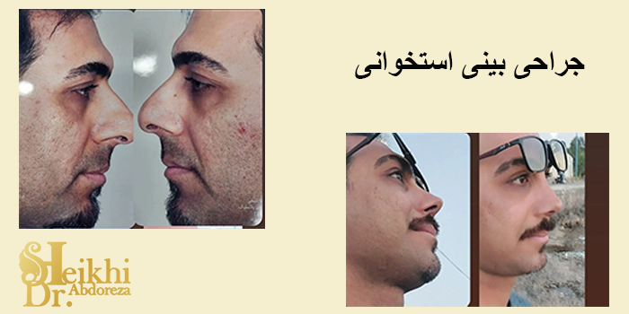 جراحی بینی استخوانی