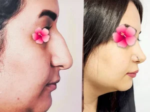 جراحی بینی استخوانی