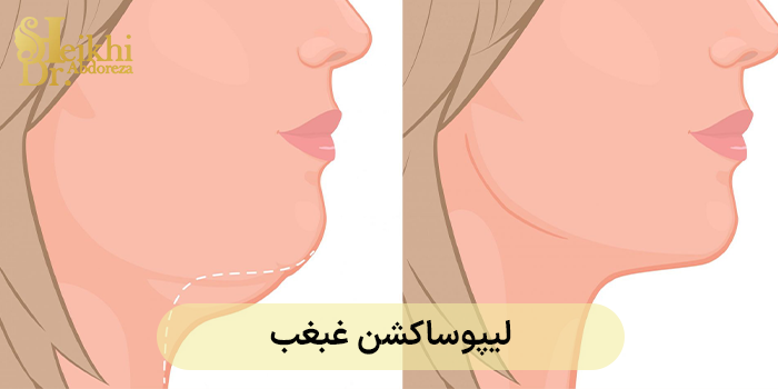 لیپوساکشن غبغب