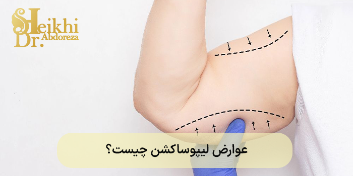 عوارض لیپوساکشن