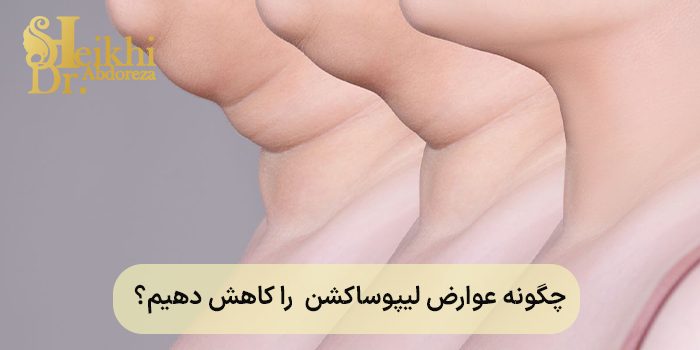 چگونه عوارض لیپوساکشن را کاهش دهیم؟