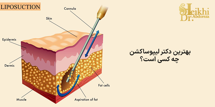 بهترین دکتر لیپوساکشن