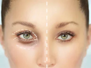 مراقبت های بعد از بلفاروپلاستی