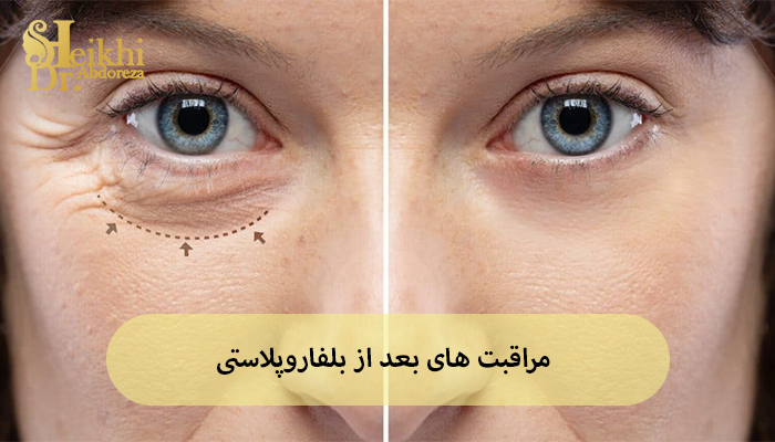 مراقبت های بعد از بلفاروپلاستی