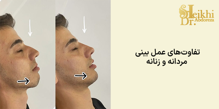 تفاوتهای عمل بینی مردانه و زنانه