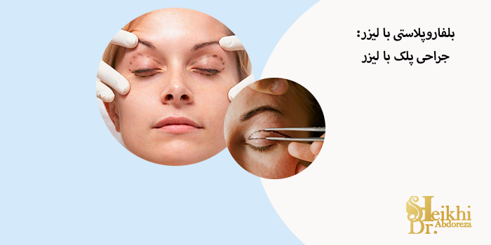 بلفاروپلاستی با لیزر