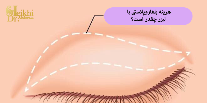 هزینه بلفاروپلاستی با لیزر چقدر است؟
