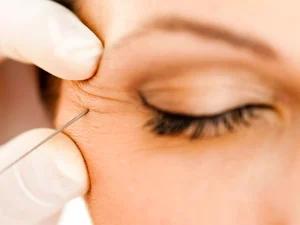 هزینه تزریق بوتاکس