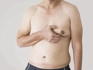 بازگشت ژنیکوماستی بعد از جراحی