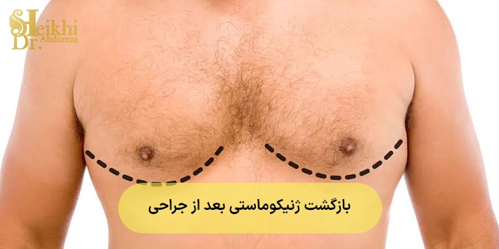 آیا ژنیکوماستی بعد از جراحی برمیگردد؟ بررسی علت و راههای پیشگیری